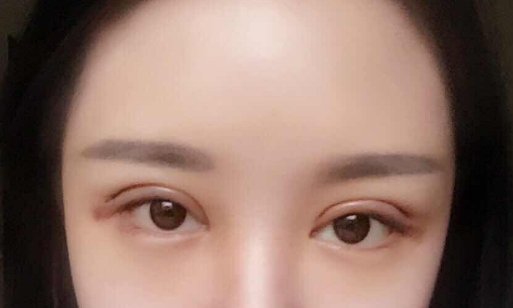 全切雙眼皮手術(shù)多少錢一次？