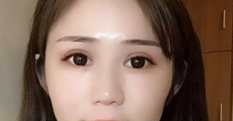 全切雙眼皮會(huì)越來(lái)越窄嗎？全切雙眼皮消腫的辦法有哪些？