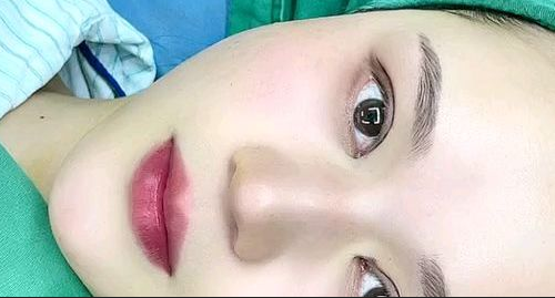 全切雙眼皮多長時間能恢復(fù)？