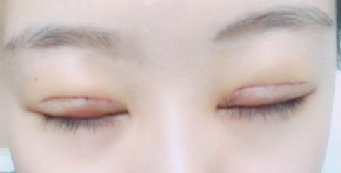 全切雙眼皮術(shù)后會留疤嗎？