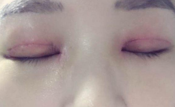 全切雙眼皮不對稱怎么辦？