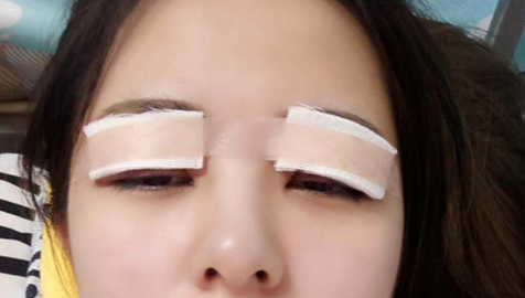 全切雙眼皮怎么恢復快？