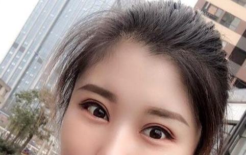 全切雙眼皮多長時間恢復(fù)自然？