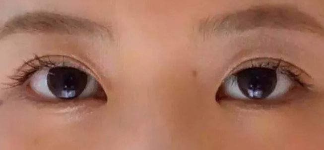 全切雙眼皮術(shù)后會(huì)疼幾天？