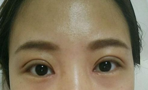 全切雙眼皮術(shù)后會(huì)留疤嗎？