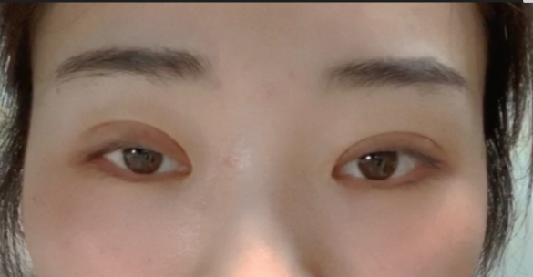 什么是全切雙眼皮？全切雙眼皮的恢復(fù)時間？