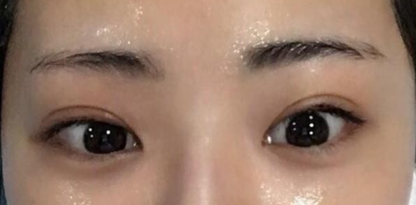 雙眼皮全切的風險有哪些？
