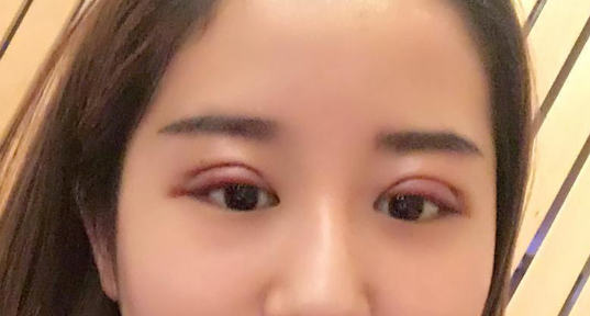 全切雙眼皮好不好？全切雙眼皮多長時(shí)間恢復(fù)自然？