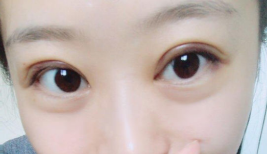 全切雙眼皮手術(shù)時間？全切雙眼皮術(shù)后會反彈嗎？