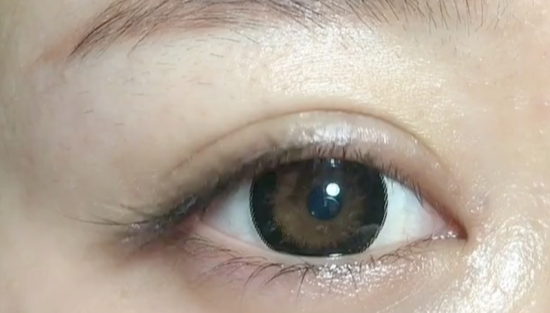 全切雙眼皮失敗可以修復(fù)嗎？