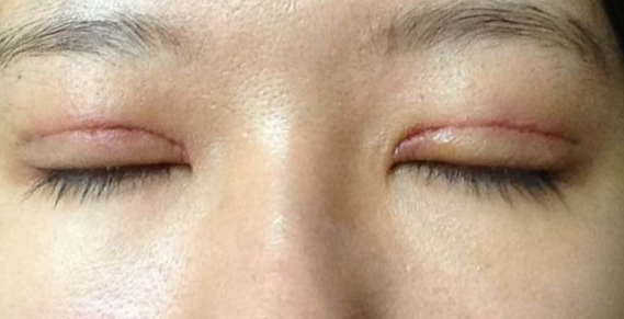 全切雙眼皮到底疼不疼？
