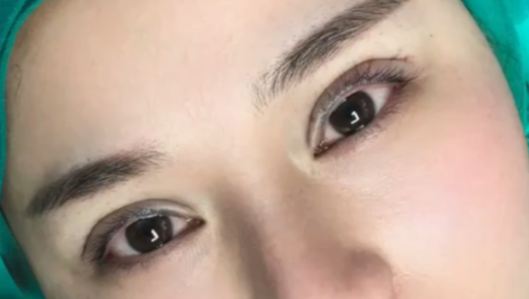 全切雙眼皮有危險(xiǎn)嗎？