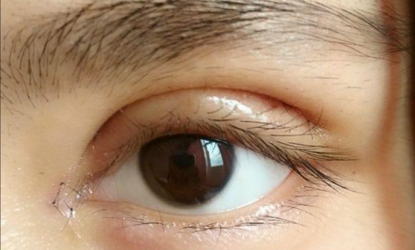 全切雙眼皮會(huì)留疤嗎？