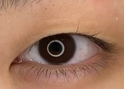 全切雙眼皮幾天可以洗臉？