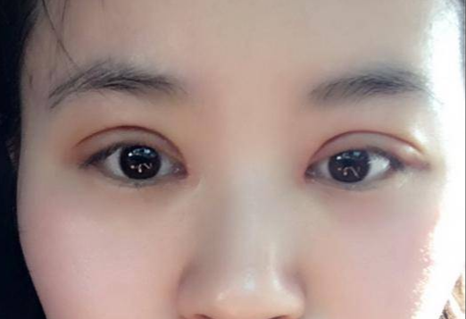 做全切雙眼皮多少錢(qián)？