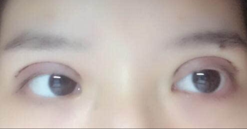 全切雙眼皮修復(fù)后恢復(fù)期多久？