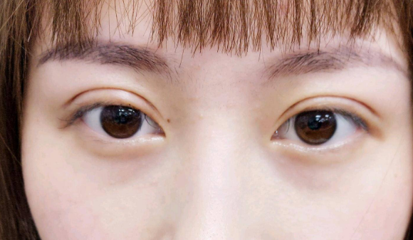 埋線雙眼皮需要拆線嗎？