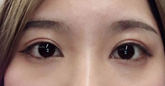 埋線雙眼皮幾天可以碰水？埋線雙眼皮有哪些注意事項？