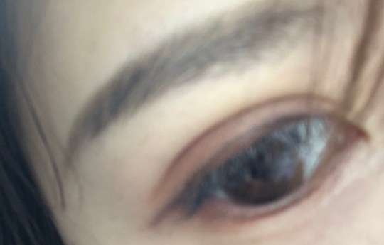 埋線雙眼皮手術(shù)優(yōu)勢(shì)有哪些？