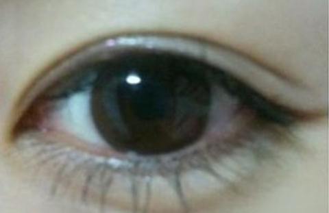 雙眼皮埋線怎么消腫快？