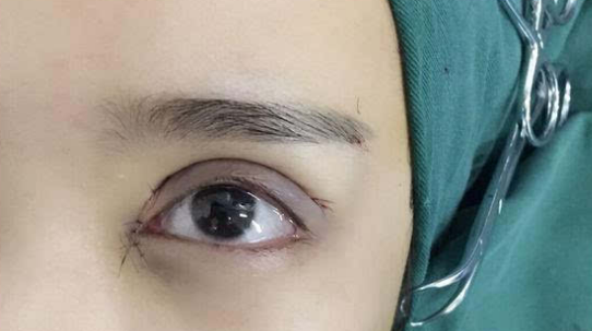 埋線雙眼皮會(huì)不會(huì)脫線？