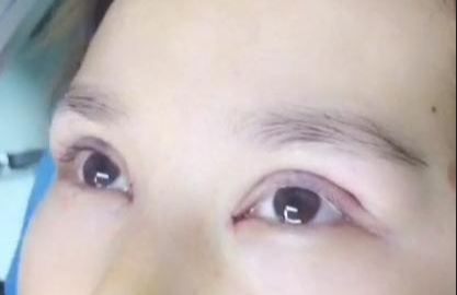 埋線雙眼皮有哪些注意事項？