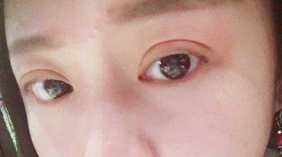 埋線雙眼皮可以保持幾年？埋線雙眼皮的危害有哪些？