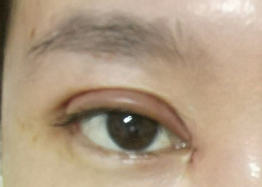 埋線雙眼皮可以維持幾年？