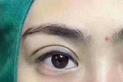 埋線雙眼皮貴不貴？