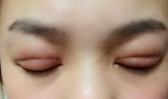 埋線雙眼皮幾天能消腫？