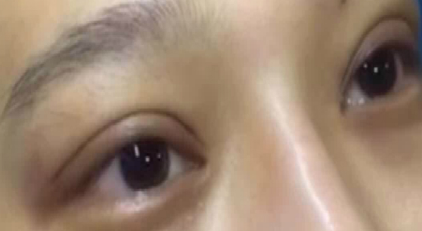 埋線雙眼皮大概能保持幾年?。柯窬€雙眼皮需要拆線嗎？