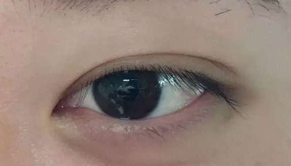 埋線雙眼皮有沒(méi)有危害？