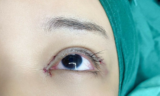 埋線雙眼皮消失怎么辦？