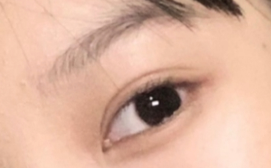 什么是雙眼皮定點？