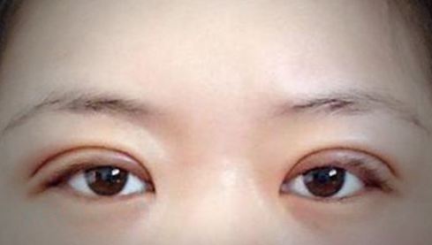 定點(diǎn)雙眼皮幾天能恢復(fù)好？