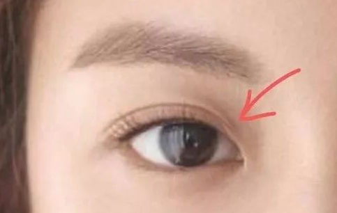 定點(diǎn)雙眼皮一般多少錢(qián)？