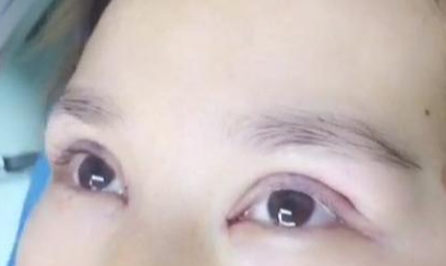 定點雙眼皮手術效果自然嗎？定點雙眼皮失敗怎么修復？