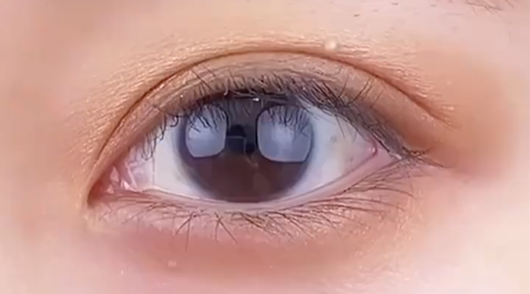 定點雙眼皮多少錢？