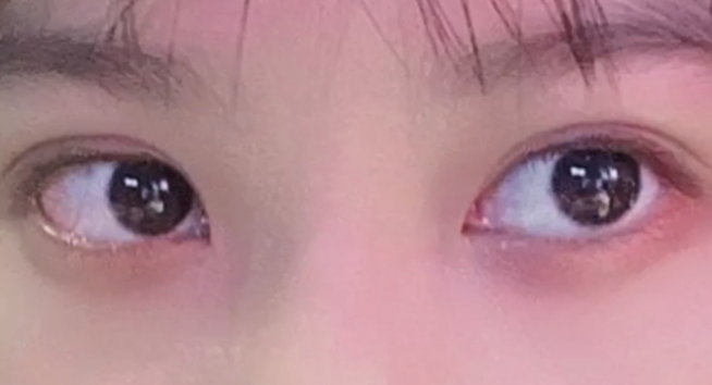 雙眼皮定點(diǎn)能維持多久？