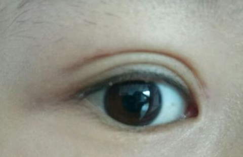 定點(diǎn)雙眼皮是怎么做的？