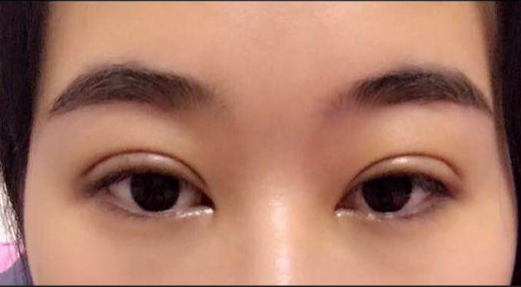 單眼皮割雙眼皮風險大嗎？