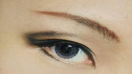 疤痕皮膚可以割雙眼皮嗎？