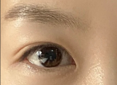 割雙眼皮后自然嗎？割雙眼皮后有危害嗎？