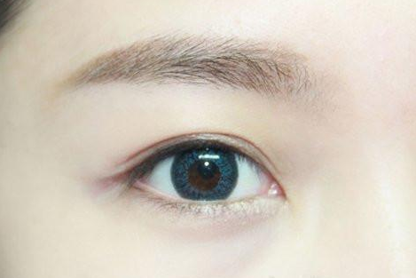 割雙眼皮幾個(gè)月定型？