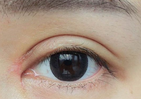半切雙眼皮是永久的嗎？半切和全切雙眼皮的區(qū)別？