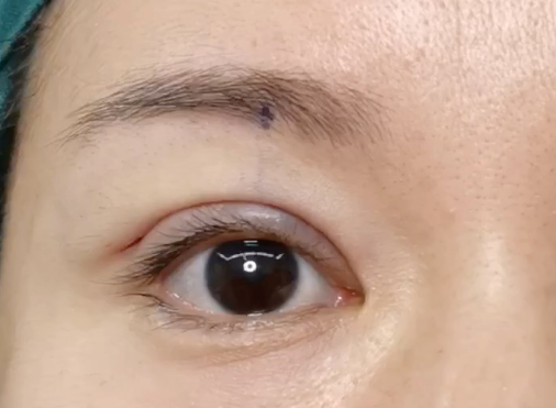 割雙眼皮后有危害嗎？