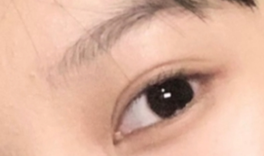 割雙眼皮恢復(fù)需要多久？割雙眼皮會(huì)不會(huì)很痛？