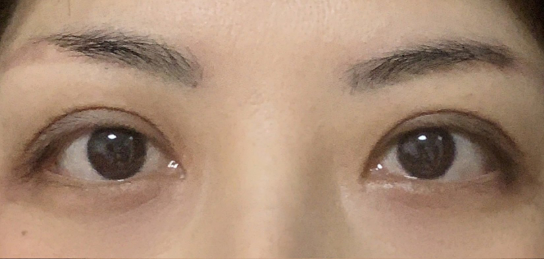 定點(diǎn)雙眼皮會(huì)腫嗎？