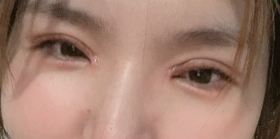 割雙眼皮后要冰敷多久？