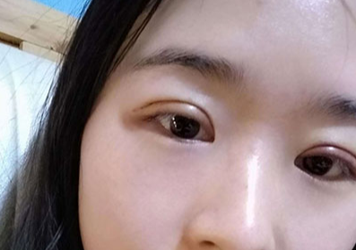 割雙眼皮后眼睛會變大嗎？